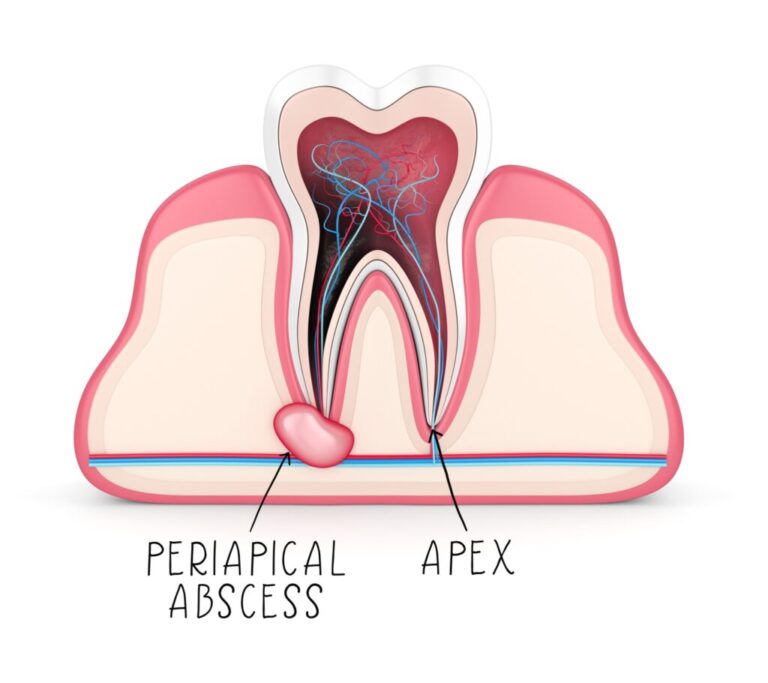 What Is a Periapical Abscess? Signs, Causes, and Expert Treatment in Canton, Michigan
